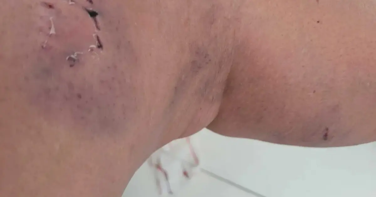 mulher atacada por cães em Feira de Santana