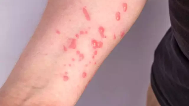 mpox