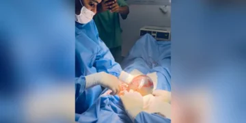 bebê nasceu empelicado em Santo Antônio de Jesus