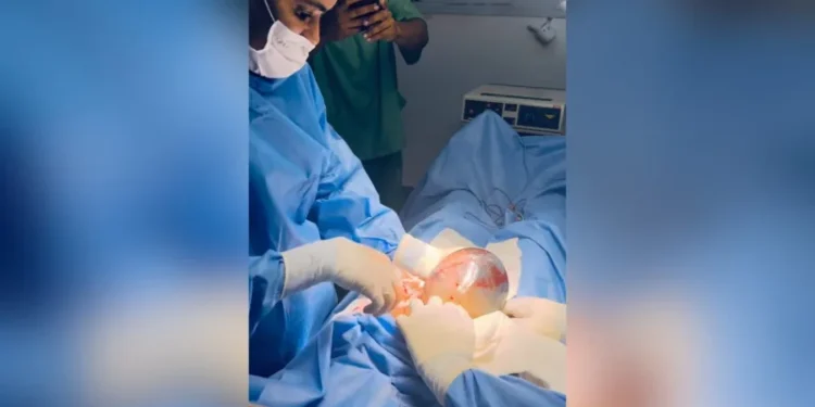 bebê nasceu empelicado em Santo Antônio de Jesus