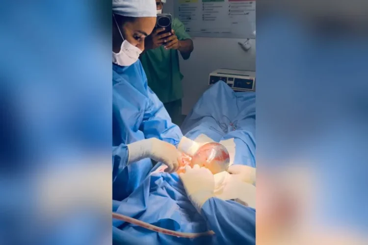 bebê nasceu empelicado em Santo Antônio de Jesus