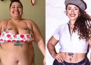 Abdominoplastia: médico explica o que esperar da recuperação pós-cirúrgica
