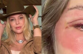Thais Gebelein exibe recuperação após cirurgia nas pálpebras