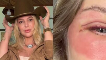 Thais Gebelein exibe recuperação após cirurgia nas pálpebras 1 Thais Gebelein exibe recuperação após cirurgia nas pálpebras