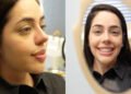 Rinoplastia de namorada de Giovani traz novos detalhes