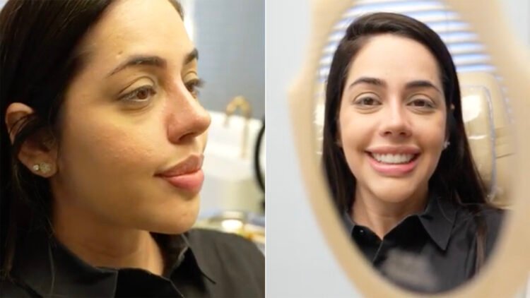 Rinoplastia de namorada de Giovani traz novos detalhes